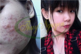 Liệu Trình Điều Trị Mụn Cho Khách Hàng TN111016 - Mụn Ẩn Trong Da - Mụn Thâm - Mụn Mũ